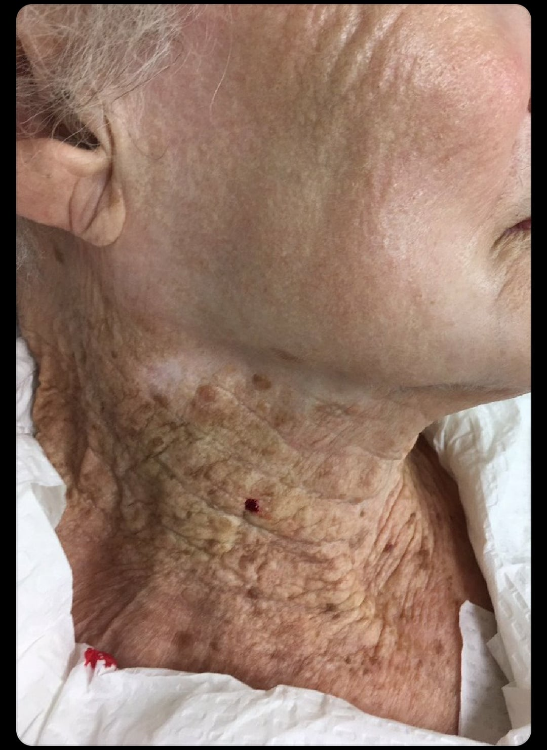 Close-up of aged skin on the neck and cheek showing sun damage, illustrating the importance of proper sunscreen application for skin protection